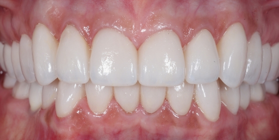 Smile with whiter teeth after getting veneers