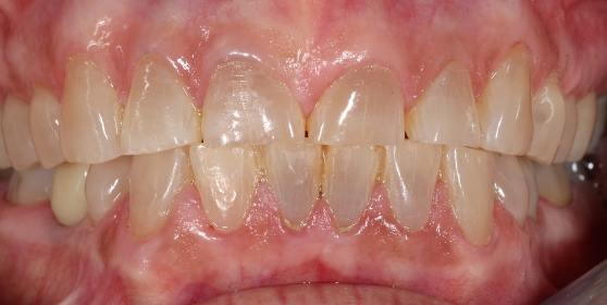 Smile with multiple discolored teeth
