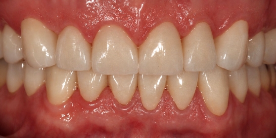 Smile with whiter teeth after getting veneers