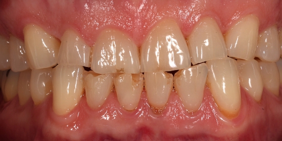Smile with multiple discolored teeth