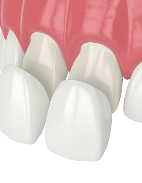 Illustration of veneers being placed on front teeth